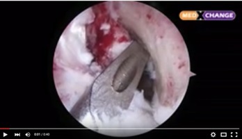 Arthroscopy 2 Surgery - Med X Change